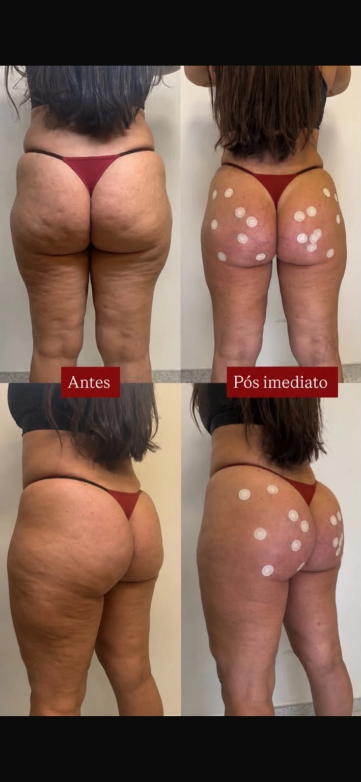 Before and after gluteal treatment, patient one