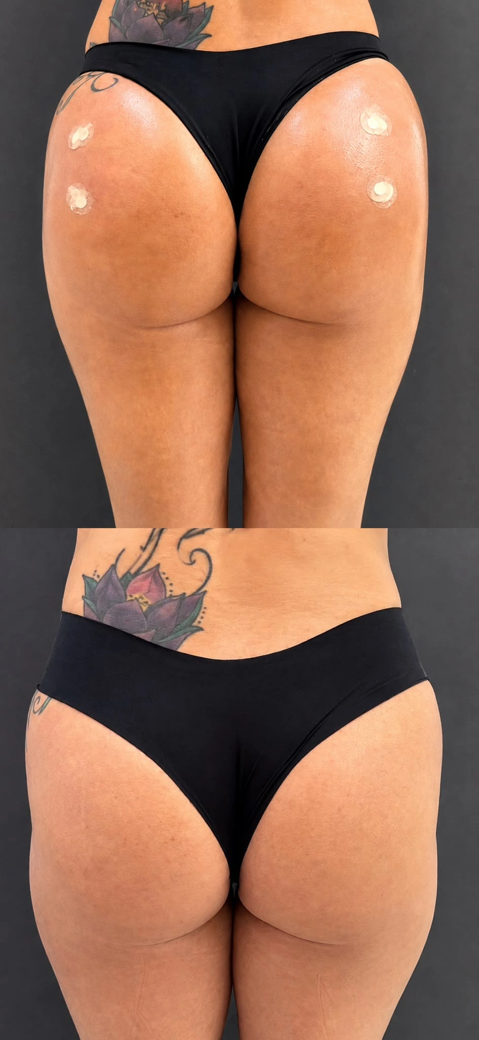 Before and after gluteal treatment, patient two