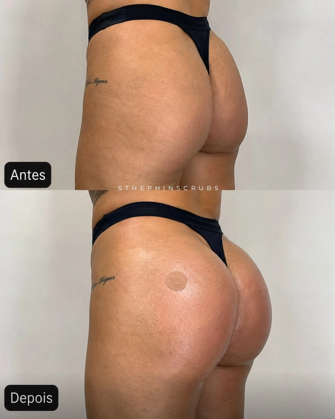 Before and after gluteal treatment, patient three